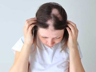 ผมร่วงเป็นหย่อม (Alopecia Areata) โรคที่ทำให้ขาดความมั่นใจ เช็กเลยเกิดจากอะไรได้บ้าง