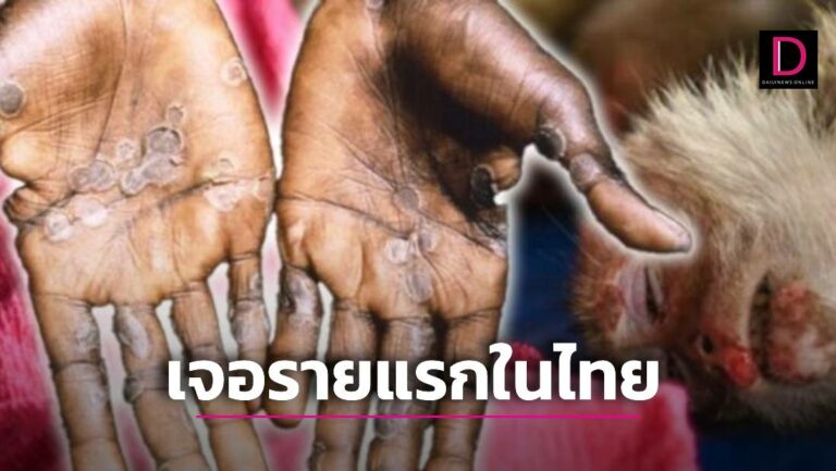 ด่วน! พบแล้ว ‘ฝีดาษลิง’ รายแรกในไทย โผล่ภูเก็ตเป็นชายชาวไนจีเรีย